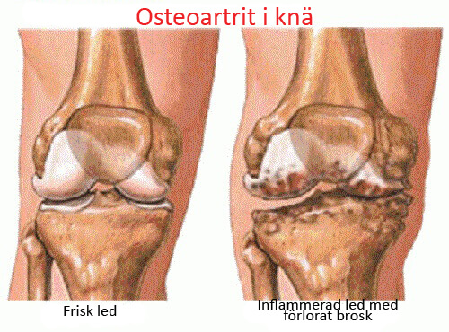 Osteoartrit i knäna