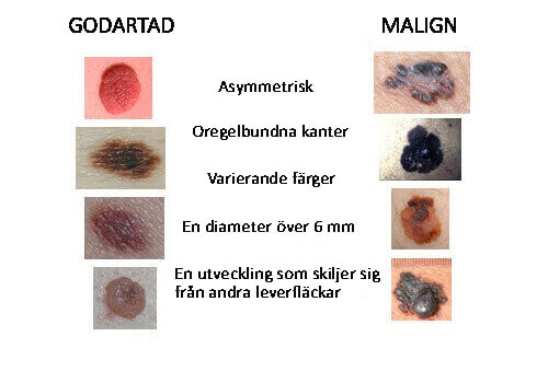 Varningstecken på hudcancer att vara uppmärksam på - Steg för Hälsa