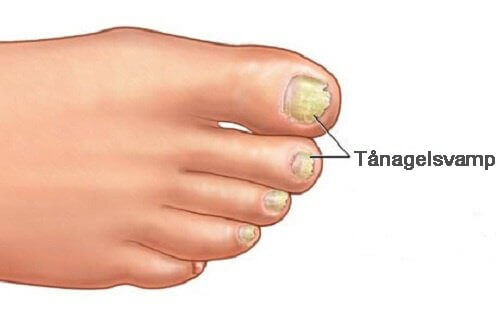 Huskurer som eliminerar svampinfektioner