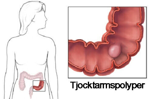 Tjocktarmspolyper: Detta behöver du veta