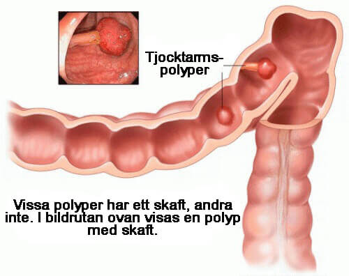 tjocktarmspolyper