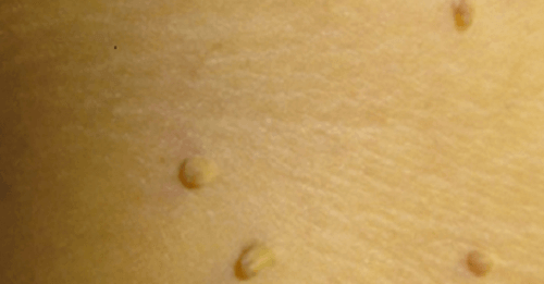 Ta bort vårtor naturligt med dessa 10 huskurer