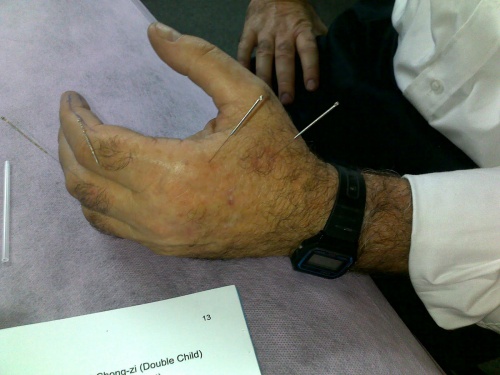 Akupunktur på handen