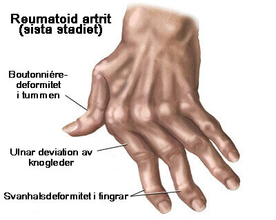 7 naturliga kurer mot artrit i händerna