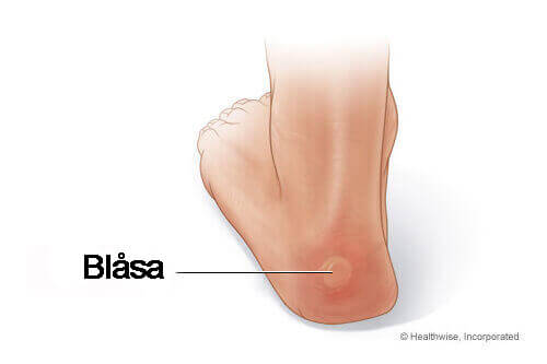 Blåsa på fot