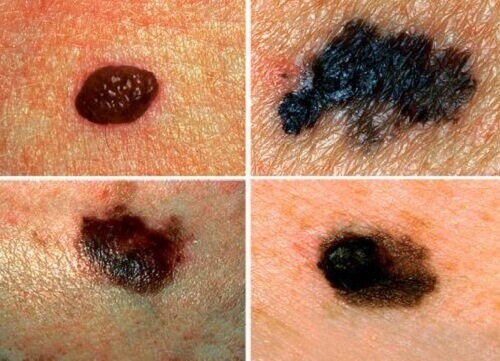 Lär dig att upptäcka möjlig hudcancer