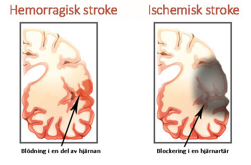 Får man för lite sömn på natten kan detta allvarligt påverka hälsan