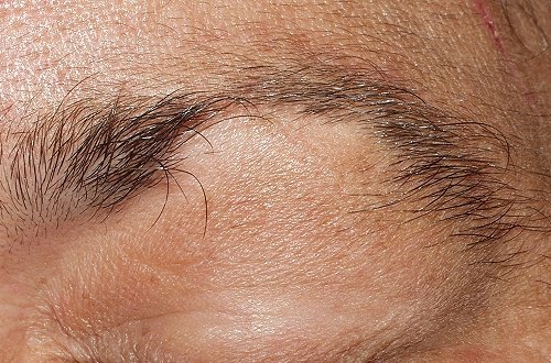 Behandla håravfall från ögonbryn och ögonfransar
