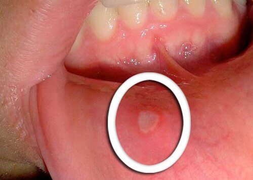 Bekämpa munsår med avokado