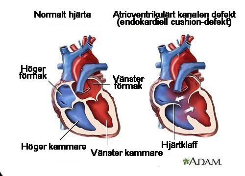 7 symtom på blåsljud du bör känna till