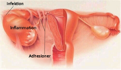 Symtom för bäckeninflammation (PID)