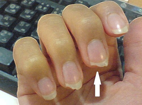 Naglar någon bitit på