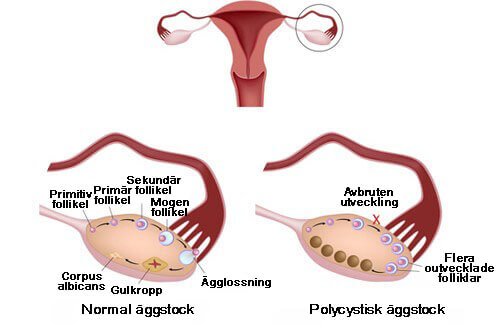 polycystiskt ovariesyndrom polycystiskt ovariesyndrom
