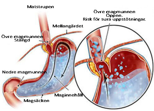 Tips för att minska sura uppstötningar