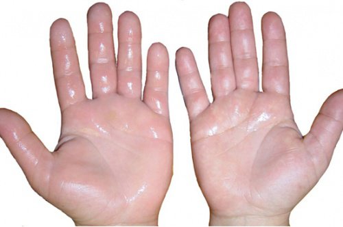 6 effektiva huskurer för svullna händer