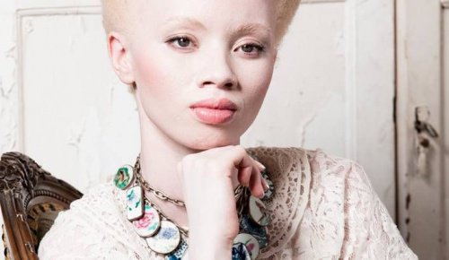 Albinism: Historien om modellen Thando Hopa