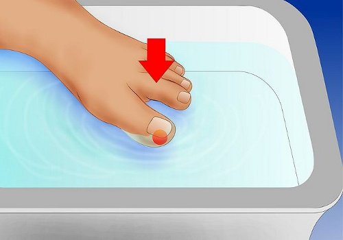 Behandla inåtväxande tånaglar på rätt sätt