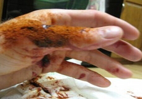 En gel som stoppar blödningar på 10 sekunder