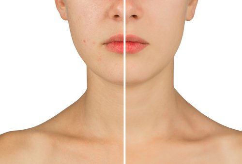 perosn med ren och oren hy