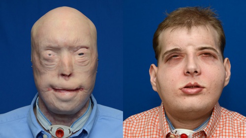 En 41-årig brandman en komplett ansiktstransplantation