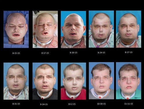 Den mest kompletta ansiktstransplantationen