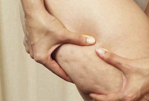 7 livsmedel som möjligtvis orsakar celluliter