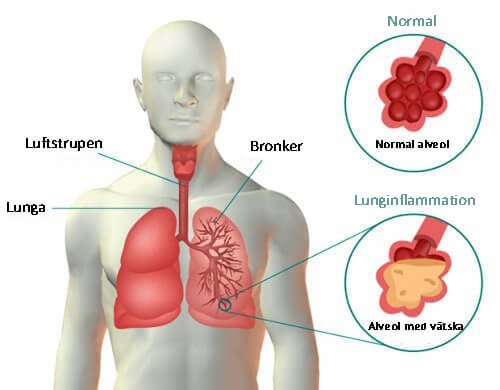 förändringar på lungan efter lunginflammation