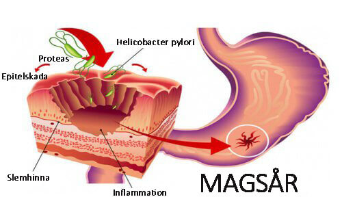 Så bekämpar du bakterien Helicobacter pylori