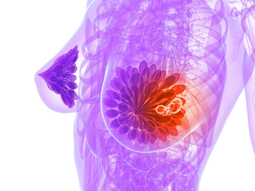 Bröstcancer