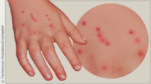 Borrelia