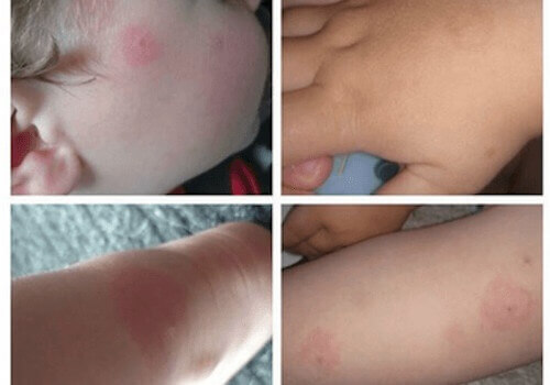 Borrelia och de många riskerna med denna sjukdom