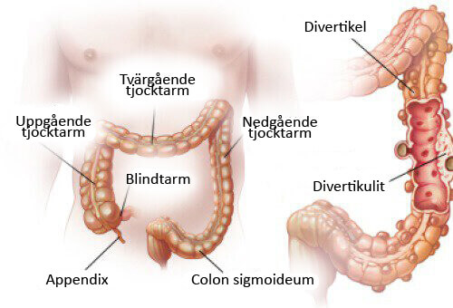 Divertikulit och divertikulos: Diagnos och behandling