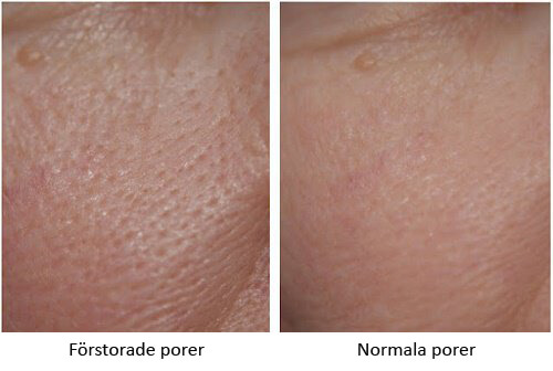 Förstorade porer? Prova dessa 3 masker!