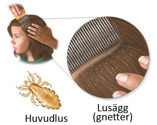 5 hemgjorda kurer för att bekämpa löss