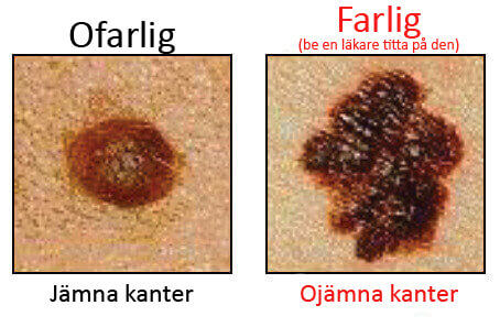 Leverfläckar
