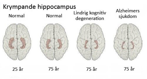 Tecken på Alzheimers - så lär du dig att känna igen dem