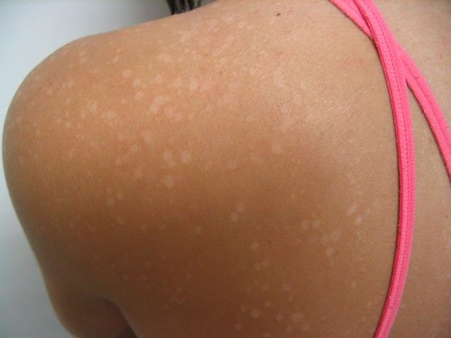 Vita fläckar på huden – Vad orsakar dem?