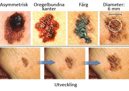 Hur du identifierar de första tecknen på melanom