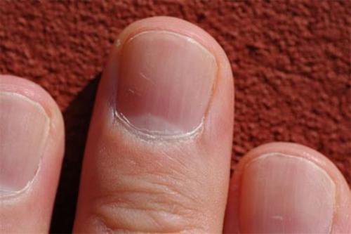 Visste du att dina naglar kan säga mycket om din hälsa?