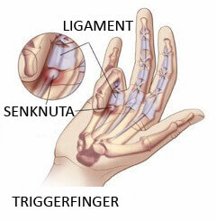 Triggerfinger