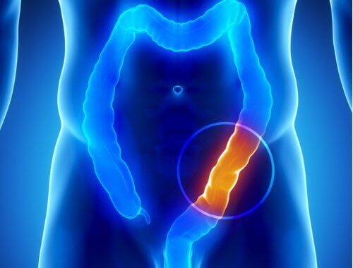 90% av sjukdomar orsakas av en ohälsosam grovtarm