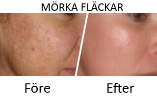 Behandla mörka fläckar