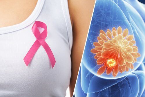 10 varningstecken på bröstcancer du måste känna till