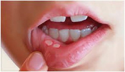 svamp på tungan huskur