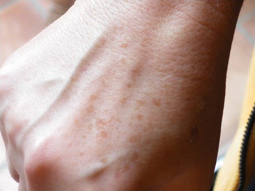 Behandla fräknar: använd dessa huskurer