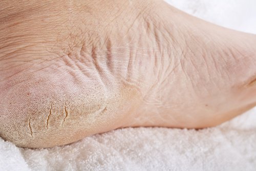 8 effektiva huskurer mot spruckna hälar