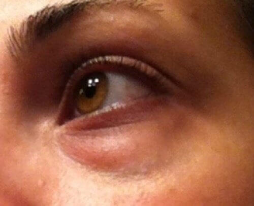 Naturliga sätt att behandla ringar under ögonen