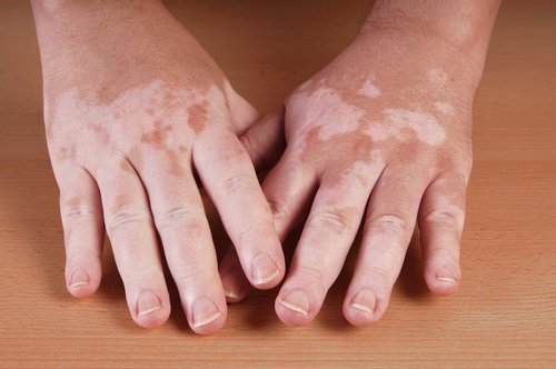 5 hoppfulla naturliga huskurer för vitiligo