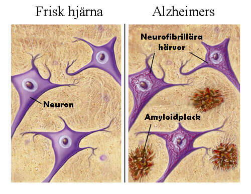 Livsmedel som skyddar mot Alzheimers