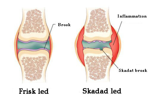 Kurer för att motverka smärta vid artrit